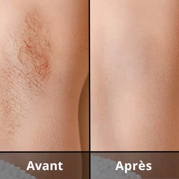 ÉPILATEUR IPL